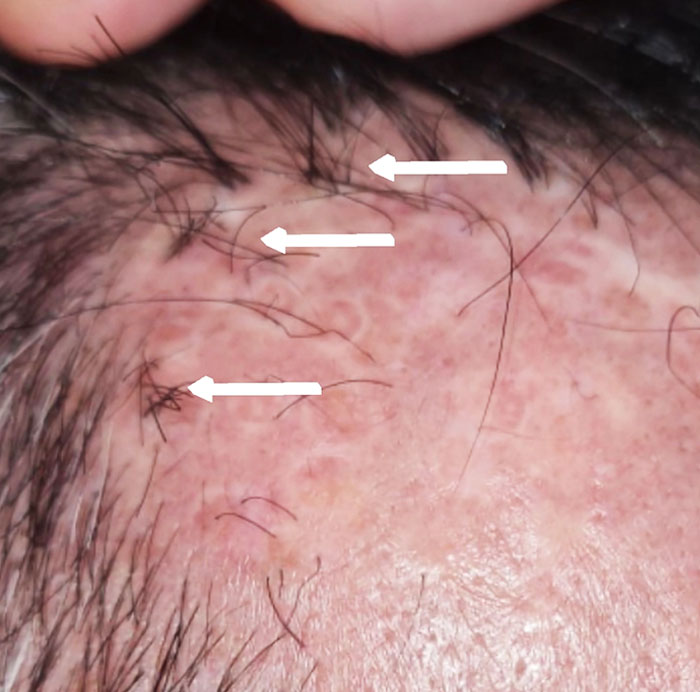 Removal of Hair Transplants in Sydney