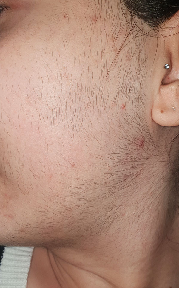 Laser Induced Hair Growth